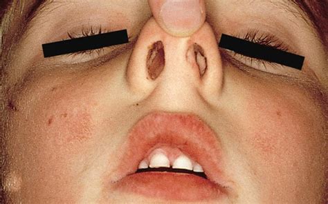 Symptoms include trouble breathing through the nose, loss of smell, decreased taste, post nasal drip, and a runny nose. Nasal polyps | SMARTY PANCE