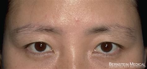 Eyebrow hair loss could cause itchiness and dry skin; Eyebrow Restoration Photos: Patient BAG | Bernstein Medical