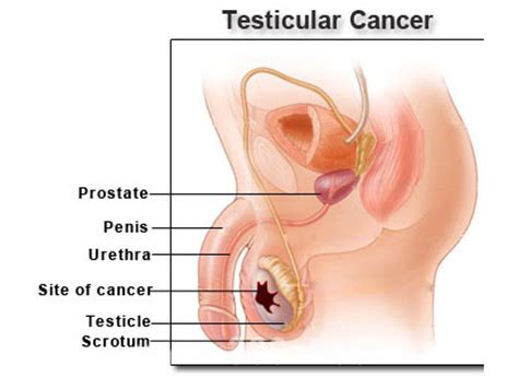 Lymph nodes are glands that make up your immune system. Testicular Cancer | Modern Cancer Hospital Guangzhou, China