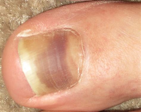 Over a period of time the black spot on nail disappears as the nail starts to. Toenail discoloration: causes, risks and ways to treat ...