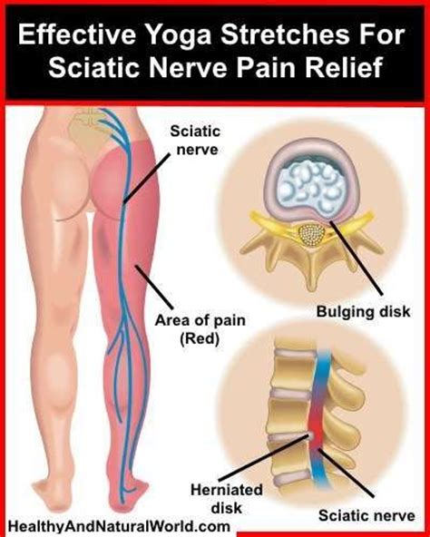 Avoid doing any exercises that have quick or jerking movements until the pain has subsided. 377 best images about Physical Therapy on Pinterest | Knee ...