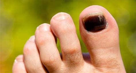 And when should i water it? Sore toe nails and/or finger nails, we can help. Zest ...