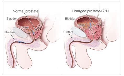 The average age of diagnosis is 66. Prostate Cancer Treatment (PDQ®)-Patient Version ...