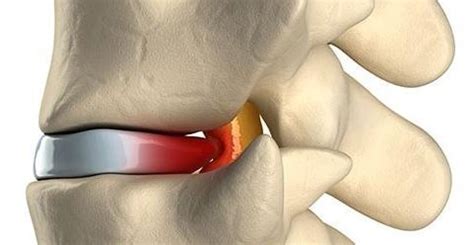 Meaning of hernia medical term. nomaslesiones.com | Tutorial de core + estiramientos para ...