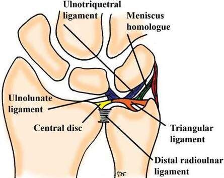 Gymnast's wrist (distal radial physeal stress syndrome). Triangular Fibrocartilage Tear TFC Surgery Orthopedic ...