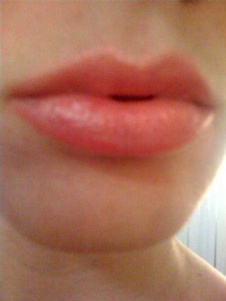 You may wish to consider applying ice to your lips to help reduce both swelling and bruising after your lip filler treatment. How to Make a Swollen Lip Go Down | Healthfully