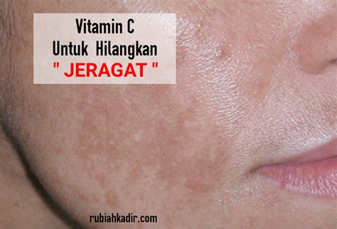 Untuk menghadapi tantangan di masa yang akan datang, studi tentang cara pembuatan dan formulasi sediaan obat yang lebih optimal selalu dikembangkan untuk memperoleh hasil yang lebih baik. Vitamin C Untuk Hilangkan Jeragat ~ Rubiah Kadir