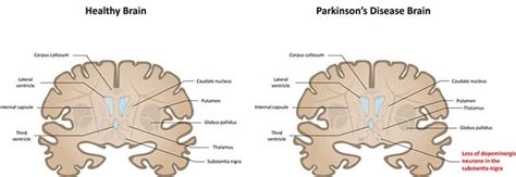 Harry brian parkinson specialist urban and contemporary art. Kan cannabis patiënten met Parkinson helpen? - RQS Blog