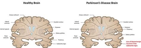 Genealogy for brian parkinson (deceased) family tree on geni, with over 200 million profiles of ancestors and living relatives. Kan cannabis patiënten met Parkinson helpen? - RQS Blog