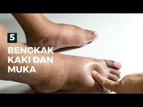 Jangan lupa tambahkan air sebanyak. SIMPTOM PENYAKIT BUAH PINGGANG - YouTube