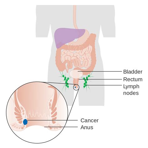 Maybe you would like to learn more about one of these? Hpv and peritoneal cancer - Peranan platyhelminthes adalah