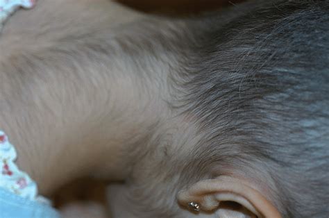 Find out about excessive hair growth (hirsutism), including when to see a gp and information about treatments and causes. -Minoxidil in alopecia areata may induce excessive hair ...