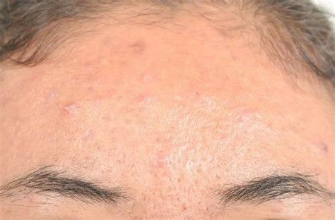 Pin su Dermatite seborroica