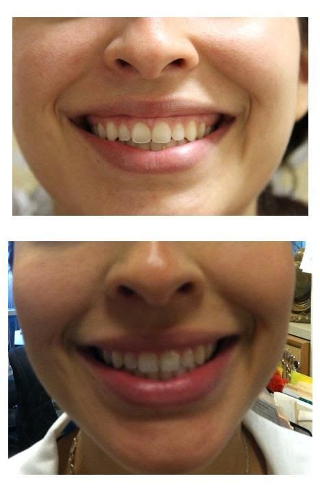 Meaning with braces the teeth will be moved out of. Fix a gummy smile with just two small injections of BOTOX ...