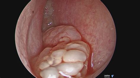 Eine sinusitis ist eine entzündung der nasennebenhöhlen. Lernen