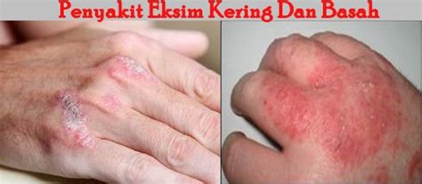 Banyak hal yang bisa menjadi pemicu timbulnya eksim. Jual Obat Gatal Kulit / Alergi / Eksim Dermatitis - Podo ...