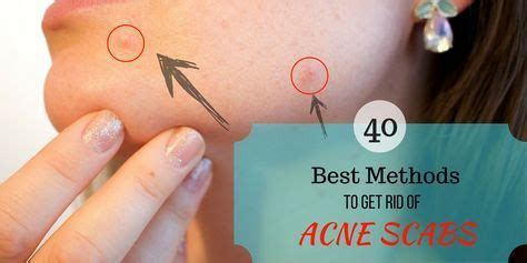 Plastic microbead free · levels of exfoliation · dermatologist tested Get rid of acne scabs overnight fast by 40 best ways of ...