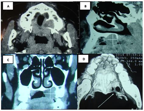 Palabras clave adenoma pleomorfo, paladar. Adenoma Pleomórfico de paladar en un paciente joven ...