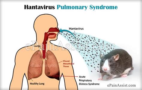 Aerosol transmission from infected rodent to rodent transmission via bites; Hantavirus pulmonary syndrome: Man dies in china after ...