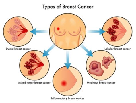 Because of this, men often don't know they have breast cancer until it is advanced. Why Does Breast Cancer Attack Men When They Have No Breast ...