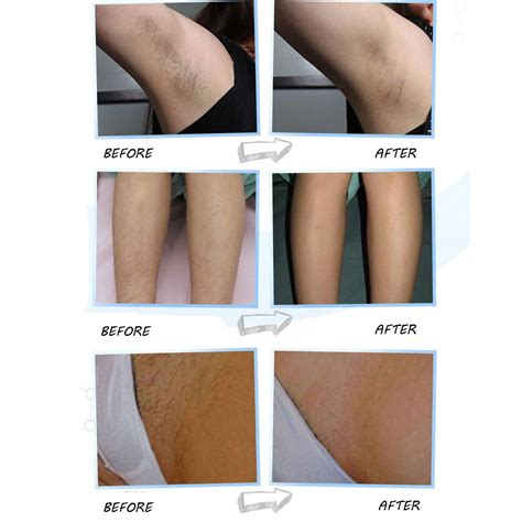 Moreover, laser hair removal can be carried out on every part of the body. Épinglé sur Your Pinterest likes