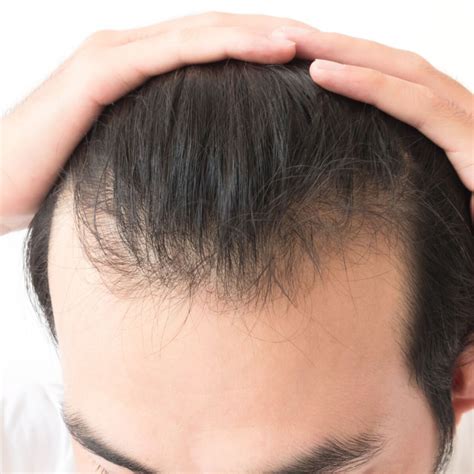 Male pattern baldness is a common form of hair loss that is caused by excess dihydrotestosterone (dht). What is DHT? (Dihydrotestosterone) - Regrowth. Your Source ...