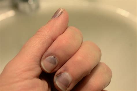 How do you remove temporary hair color? How to Remove Dye Stains From Fingernails (with Pictures ...