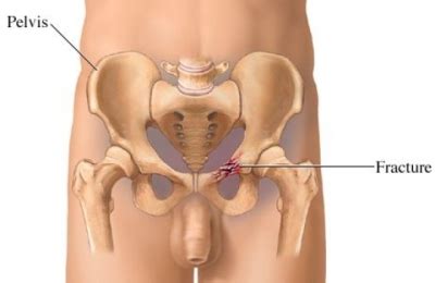 Bone cancer understanding your diagnosis. Pelvic Fracture - Cancer Care of Western New York