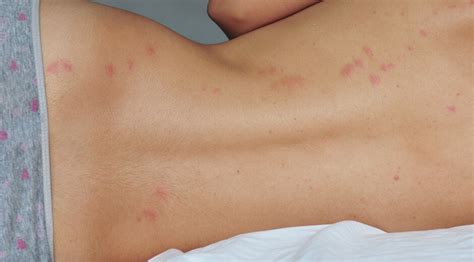 Learn about flea bites in our article flea flea bites 101. What To Know About Bed Bug Bites - Bed Bug Guide