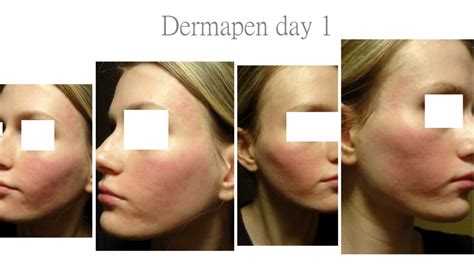 The dermapen is a fractional microneedling device. Diet logs - Vitamins and diet change - Dermapen treatment ...