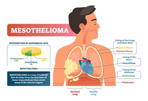 Check spelling or type a new query. 4 New and Promising Treatments for Mesothelioma - Todayz News