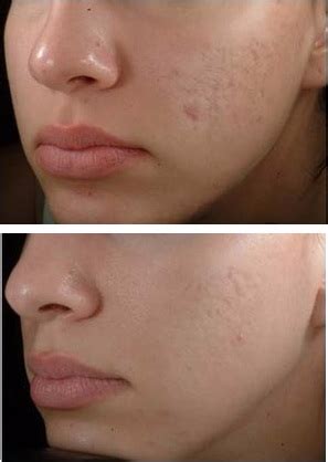 How long has the white scar with the bump on lip present? How to Get Rid of Acne Scars Overnight - Creative Ideas