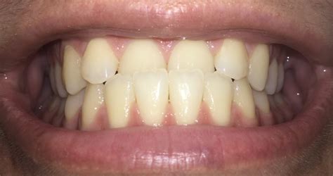 The upper jaw teeth are positioned slightly over the lower jaw teeth in a right bite. Could my crossbite qualify for free braces through medi-cal?