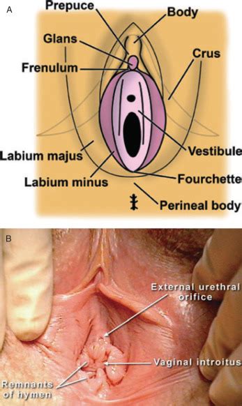 This is a vagina where the labia minora (inner lips) extend out past the labia majora (outer lips) while this is the least common, it is the way that majority of people assume that vaginas should look. The Anatomy of the Distal Vagina: Towards Unity - The ...