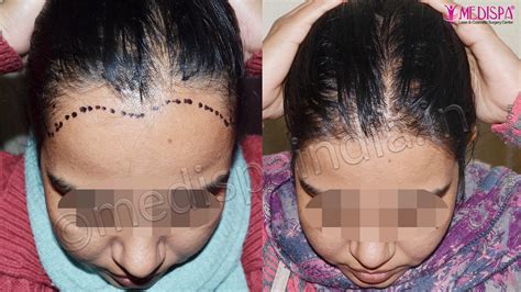 Female hair loss female hair loss: Female Hair Transplant Results After 1 Year