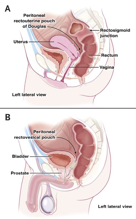 In 1938 gutman and gutman' reported raised serum. Digital Rectal Examination and Anoscopy | NEJM