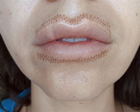 Waking up with an upper swollen, or puffy, eyelid can be disturbing and uneasy, but with these treatments, the issue can be alleviated. Services - DESERT PHOX