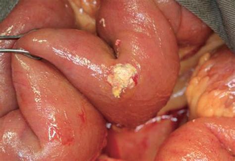 What we know and what we need to know, 2018. Ileocolonic mucormycosis in adult immunocompromised ...