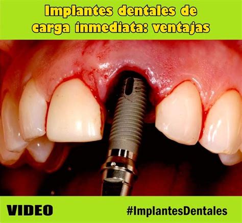What are the problems with tooth implants? IMPLANTES DENTALES de carga inmediata: ventajas | Teeth ...