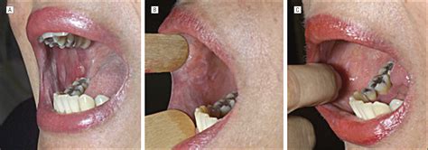 21 hertl m, zillikens d, borradori l et al. Mucocutaneous Lichen Planus With Esophageal Involvement ...