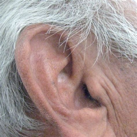 Diagonal earlobe creases and prognosis in patients with suspected coronary artery disease. The same patient with a somewhat less distinct diagonal ear lobe crease... | Download Scientific ...