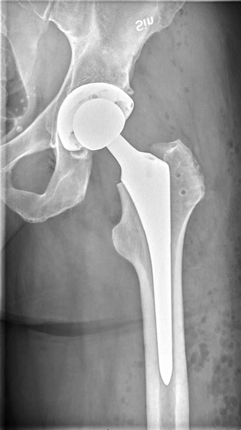 How Many Days After Hip Replacement Does Death Risk Last? » Scary Symptoms