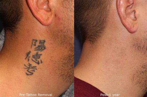 Tattoo removal has been performed with various tools since the start of tattooing. Tattoo Removal San Diego, CA | Cosmetic Laser Dermatology