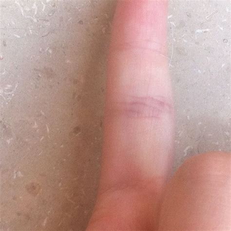 Ein bruch ist in der regel die folge einer verletzung der hand. Finger geprellt oder doch gebrochen?