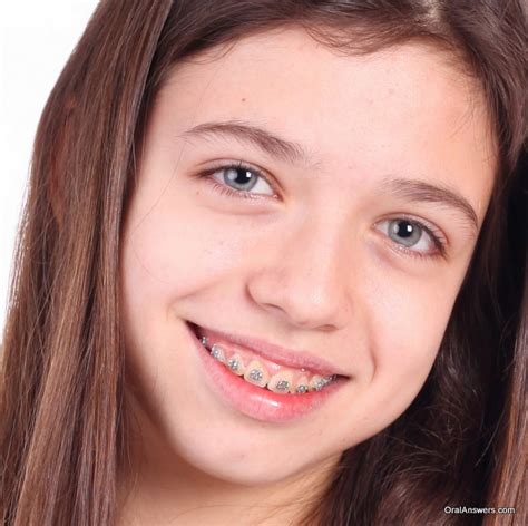 Our database has everything you'll ever need, so enter & enjoy 60 Photos of Teenagers with Braces | Oral Answers