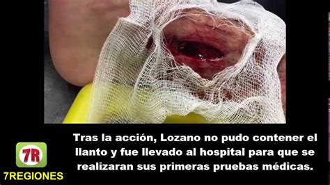 El delantero mexicano del nápoles, hiving lózano, mejor conocido como chucky, estará fuera del equipo durante tres semanas, debido a la lesión muscular que sufrió en un partido. Terrible lesión al Chucky Lozano de Michael Orozco TUZOS ...