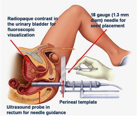 The most commonly used tests for. modern surgery: Surgery for prostate cancer