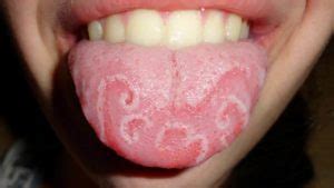 Nyc hra substance abuse and client treatment tracking and. Learning The Truths: Candidiasis Mouth