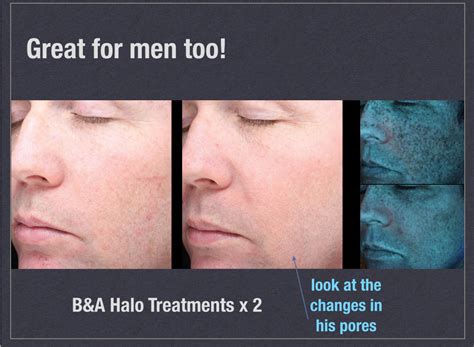 I know that usually with ipl technology it works only on dark and rather course hair and doesn't really work i have some facial hair and was keen to try anything. DOES HALO™ REALLY WORK ON PORES? - Restora Austin