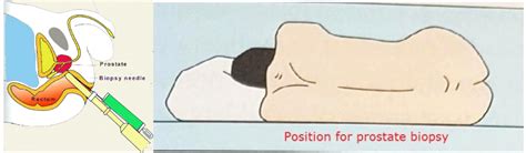 A doctor removes a sample of tissue or cells to be examined by a pathologist, usually under a microscope. Prostate Biopsy (TRUS or MRI-US fusion Method) - Chin ...